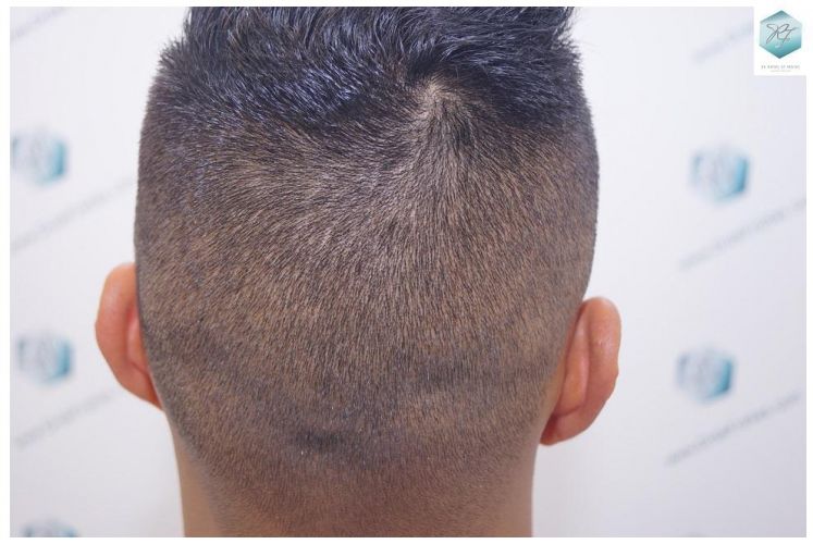 Injerto Capilar Técnica FUE 2120 Grafts (5678 Pelos) 35 trasplante de cabello