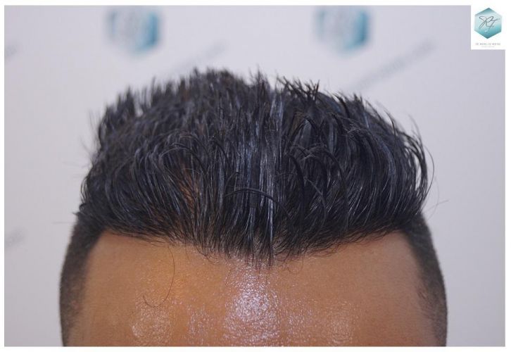 Injerto Capilar Técnica FUE 2120 Grafts (5678 Pelos) 20 trasplante de cabello