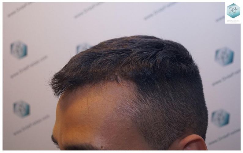 Injerto Capilar Técnica FUE 2120 Grafts (5678 Pelos) 13 trasplante de cabello