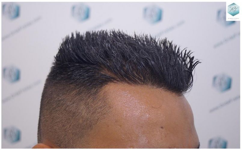 Injerto Capilar Técnica FUE 2120 Grafts (5678 Pelos) 25 trasplante de cabello
