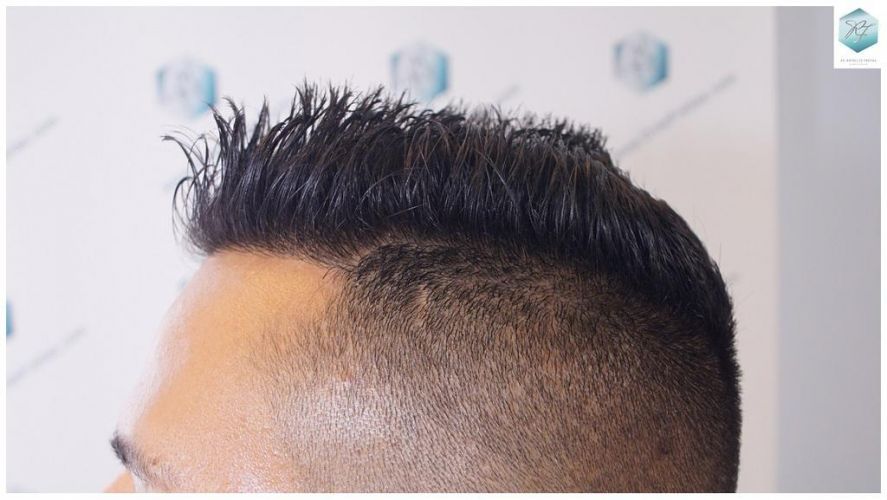 Injerto Capilar Técnica FUE 2120 Grafts (5678 Pelos) 30 trasplante de cabello