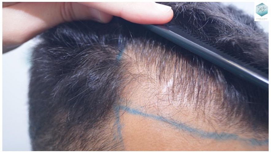 Injerto Capilar Técnica FUE 2120 Grafts (5678 Pelos) 4 injerto capilar