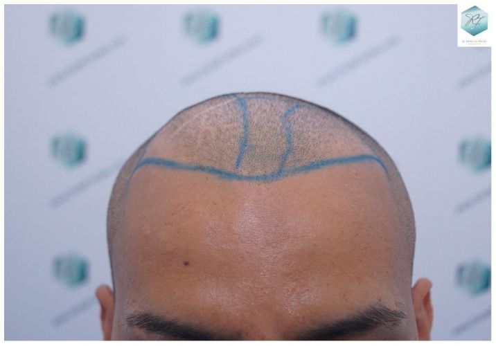 Injerto Capilar Técnica FUE 2120 Grafts (5678 Pelos) 8 injerto capilar