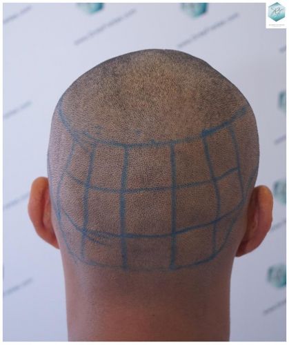 Injerto Capilar Técnica FUE 2120 Grafts (5678 Pelos) 10 injerto capilar