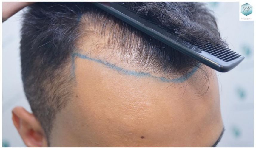 Injerto Capilar Técnica FUE 2120 Grafts (5678 Pelos) 5 pelo en las entradas