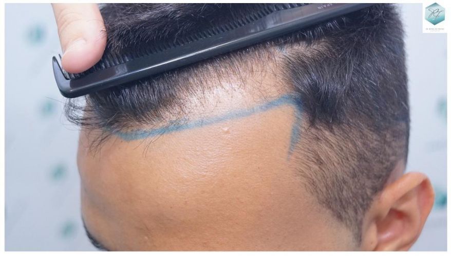 Injerto Capilar Técnica FUE 2120 Grafts (5678 Pelos) 6 pelo en las entradas