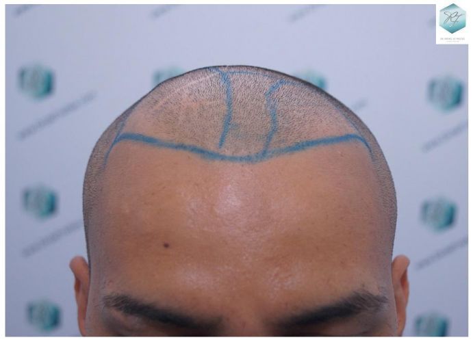 Injerto Capilar Técnica FUE 2120 Grafts (5678 Pelos) 9 trasplante de cabello