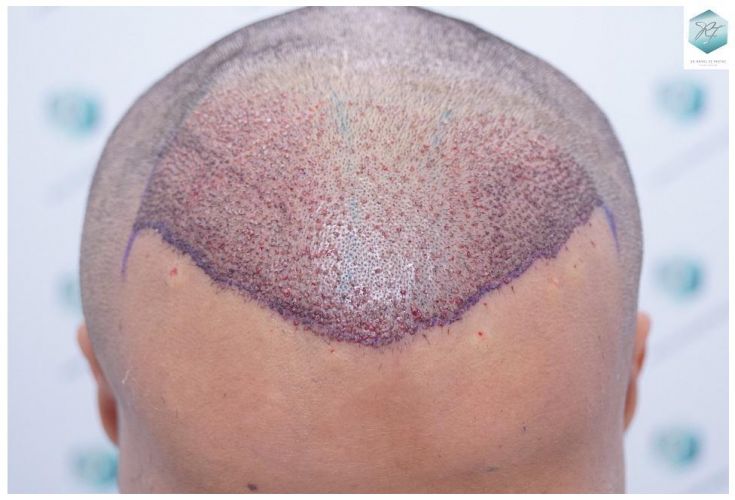 Injerto Capilar Técnica FUE 2120 Grafts (5678 Pelos) 11 trasplante de cabello