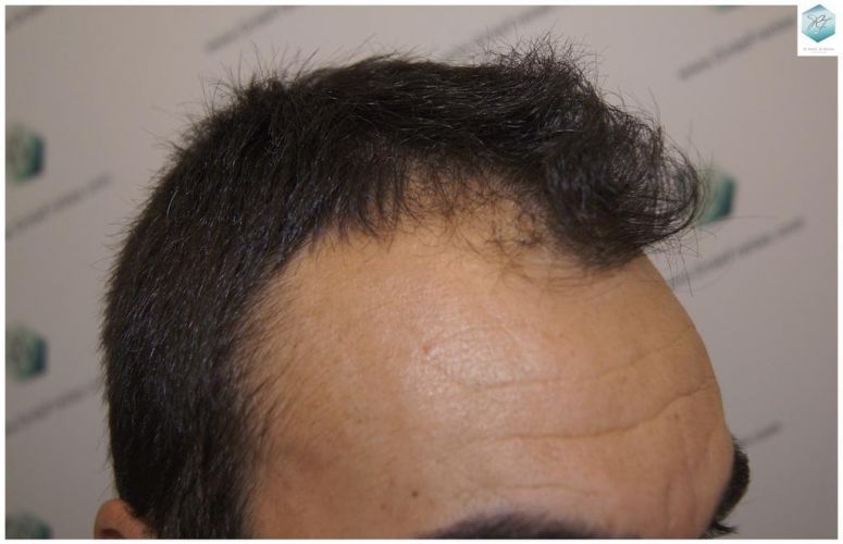 injerto pelo en españa