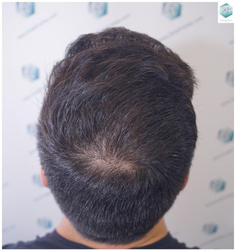 resultado trasplante de pelo