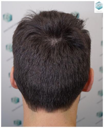 Injerto Capilar Técnica FUE 2271 Grafts (5988 Pelos) 36 tecnica fue microinjerto pelo