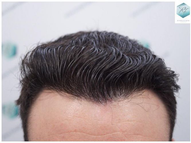 Injerto Capilar Técnica FUE 2271 Grafts (5988 Pelos) 26 injerto capilar valencia
