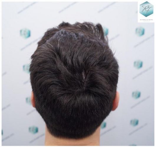 Injerto Capilar Técnica FUE 2271 Grafts (5988 Pelos) 34 injerto capilar valencia