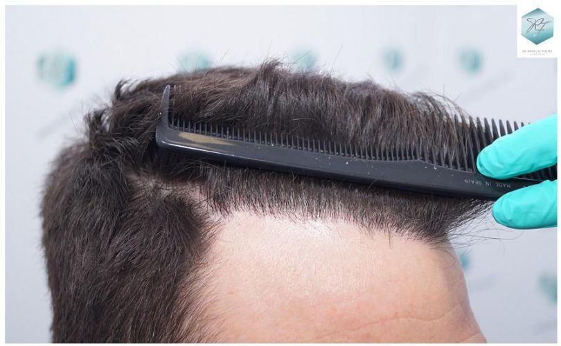 Injerto Capilar Técnica FUE 2271 Grafts (5988 Pelos) 24 injerto capilar valencia