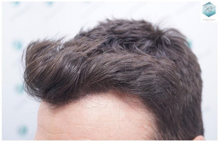 Injerto Capilar Técnica FUE 2271 Grafts (5988 Pelos) 22 injerto capilar valencia