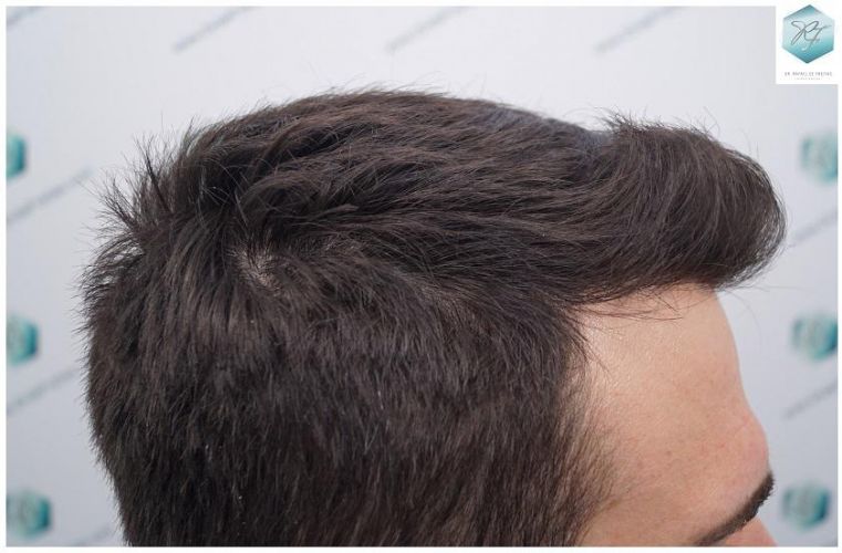 Injerto Capilar Técnica FUE 2271 Grafts (5988 Pelos) 32 injerto capilar valencia