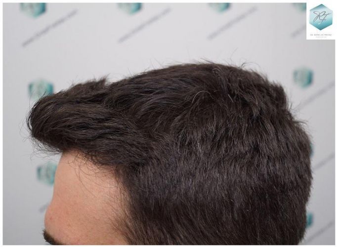 Injerto Capilar Técnica FUE 2271 Grafts (5988 Pelos) 33 injerto capilar valencia