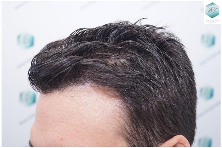 Injerto Capilar Técnica FUE 2271 Grafts (5988 Pelos) 30 injerto capilar valencia