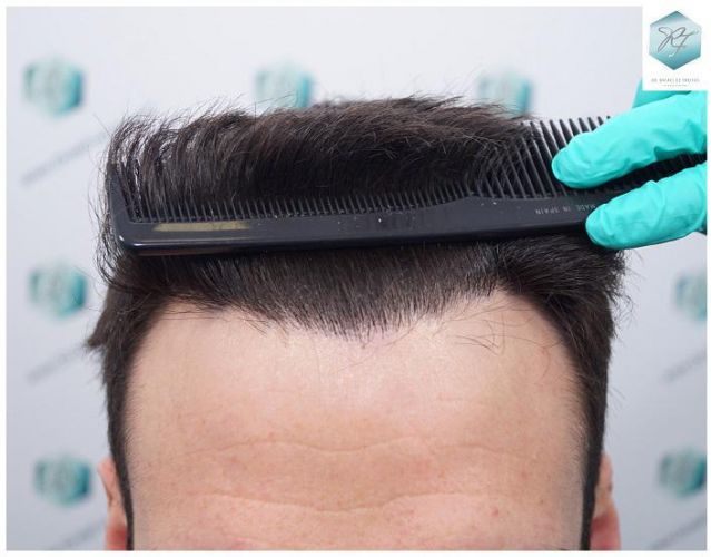 Injerto Capilar Técnica FUE 2271 Grafts (5988 Pelos) 23 tecnica fue microinjerto pelo