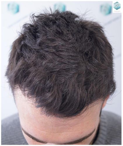 Injerto Capilar Técnica FUE 2271 Grafts (5988 Pelos) 28 tecnica fue microinjerto pelo