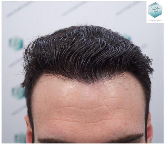 Injerto Capilar Técnica FUE 2271 Grafts (5988 Pelos) 27 trasplante capilar