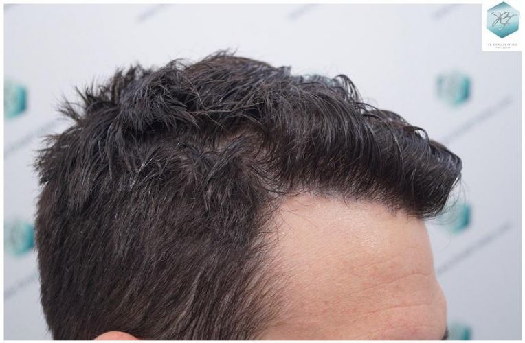 Injerto Capilar Técnica FUE 2271 Grafts (5988 Pelos) 29 trasplante capilar