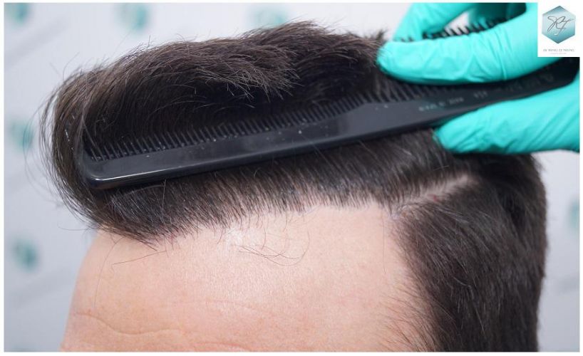 Injerto Capilar Técnica FUE 2271 Grafts (5988 Pelos) 25 trasplante capilar