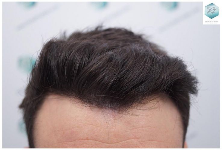 Injerto Capilar Técnica FUE 2271 Grafts (5988 Pelos) 31 injerto capilar valencia