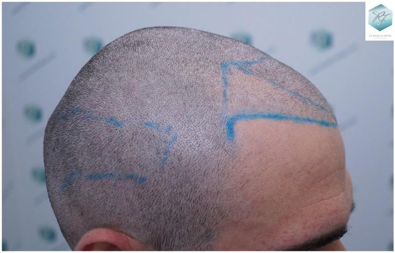 Injerto Capilar Técnica FUE 2271 Grafts (5988 Pelos) 12 recuperar el pelo