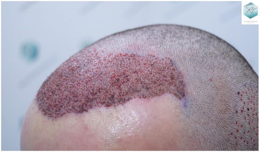 Injerto Capilar Técnica FUE 2271 Grafts (5988 Pelos) 15 diseño linea injerto