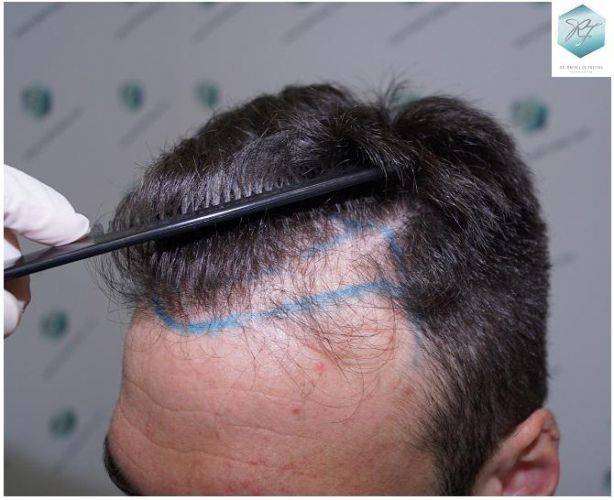 Injerto Capilar Técnica FUE 2271 Grafts (5988 Pelos) 9 recuperar el pelo