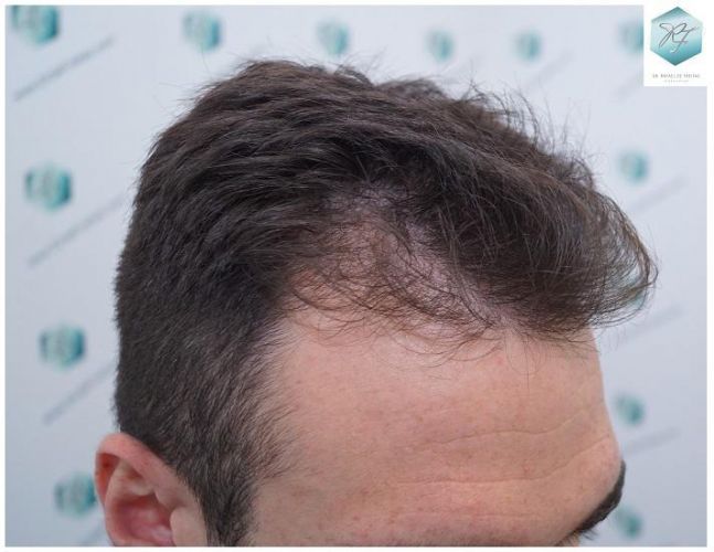 Injerto Capilar Técnica FUE 2271 Grafts (5988 Pelos) 2 recuperar el pelo