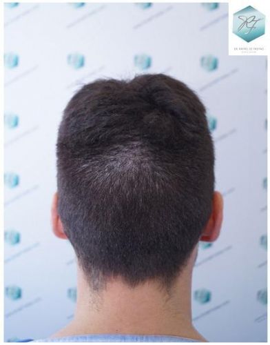 Injerto Capilar Técnica FUE 2271 Grafts (5988 Pelos) 35 recuperar el pelo
