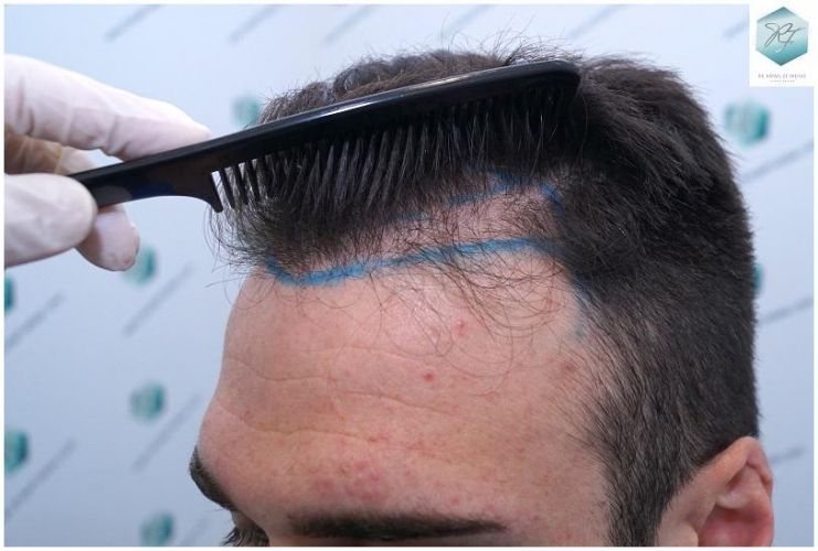 Injerto Capilar Técnica FUE 2271 Grafts (5988 Pelos) 8 recuperar el pelo
