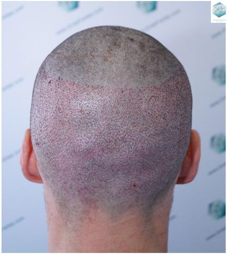 Injerto Capilar Técnica FUE 2271 Grafts (5988 Pelos) 18 tecnica fue microinjerto pelo