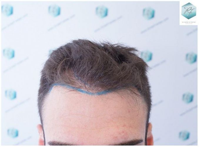 DISEÑO LINEA INJERTO CAPILAR recuperar el pelo