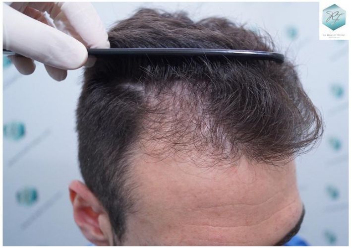 Injerto Capilar Técnica FUE 2271 Grafts (5988 Pelos) 4 recuperar el pelo