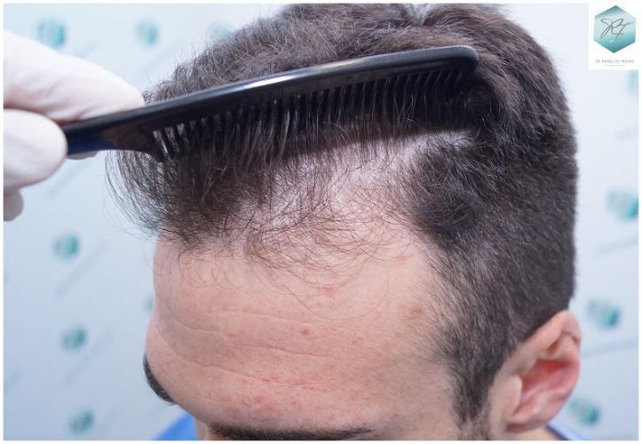 Injerto Capilar Técnica FUE 2271 Grafts (5988 Pelos) 5 recuperar el pelo