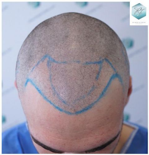Injerto Capilar Técnica FUE 2271 Grafts (5988 Pelos) 11 recuperar el pelo