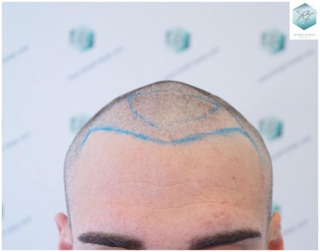 Injerto Capilar Técnica FUE 2271 Grafts (5988 Pelos) 10 recuperar el pelo