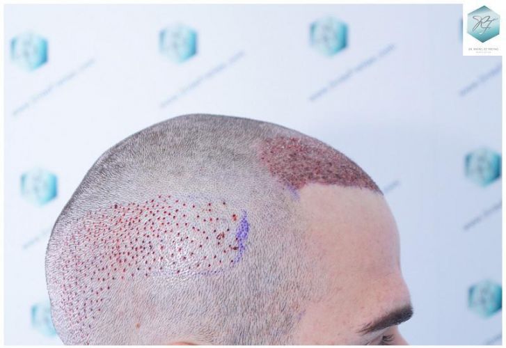 Injerto Capilar Técnica FUE 2271 Grafts (5988 Pelos) 16 tecnica fue microinjerto pelo