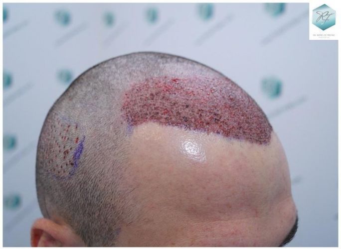 Injerto Capilar Técnica FUE 2271 Grafts (5988 Pelos) 14 tecnica fue microinjerto pelo