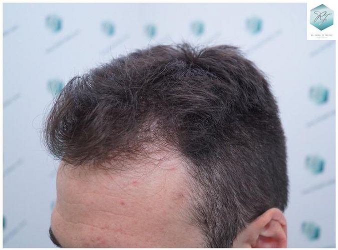 Injerto Capilar Técnica FUE 2271 Grafts (5988 Pelos) 3 recuperar el pelo