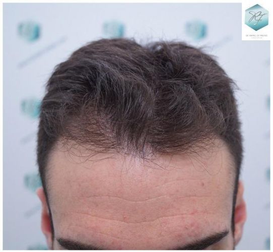 ANTES TRASPLANTE CAPILAR recuperar el pelo