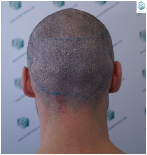 Injerto Capilar Técnica FUE 2271 Grafts (5988 Pelos) 19 diseño linea injerto