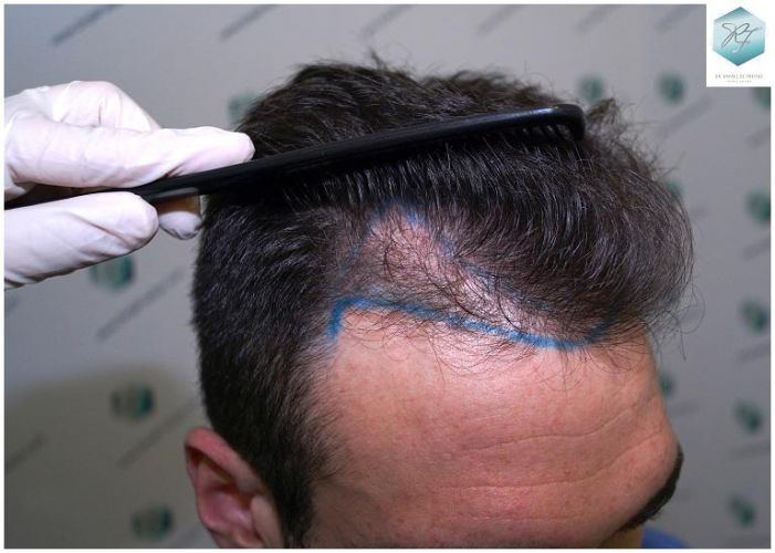 Injerto Capilar Técnica FUE 2271 Grafts (5988 Pelos) 7 diseño linea injerto