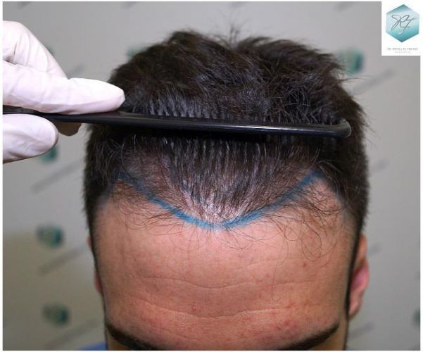 Injerto Capilar Técnica FUE 2271 Grafts (5988 Pelos) 6 diseño linea injerto