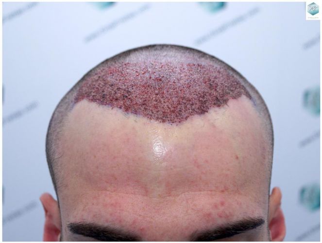 TRASPLANTE CAPILAR tecnica fue microinjerto pelo
