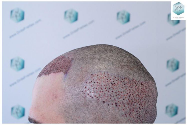 Injerto Capilar Técnica FUE 2271 Grafts (5988 Pelos) 17 tecnica fue microinjerto pelo