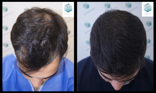Injerto Capilar Técnica FUE 3105 Grafts (7493 Pelos) 29 trasplante de pelo